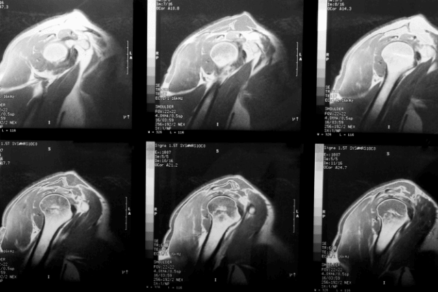 MRI of an injured rotator cuff